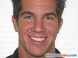 After 6 month smiles From Your Swindon Dentist