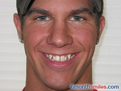 Before 6 month smiles From Your Swindon Dentist
