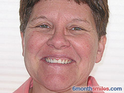 After 6 month smiles From Your Swindon Dentist