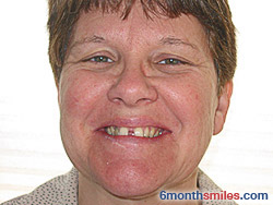 Before 6 month smiles From Your Swindon Dentist