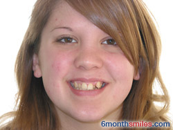 Before 6 month smiles From Your Swindon Dentist