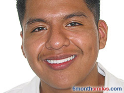 After 6 month smiles From Your Swindon Dentist