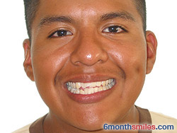 Before 6 month smiles From Your Swindon Dentist