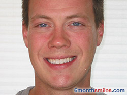 After 6 month smiles From Your Swindon Dentist