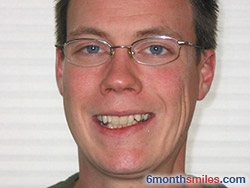 Before 6 month smiles From Your Swindon Dentist