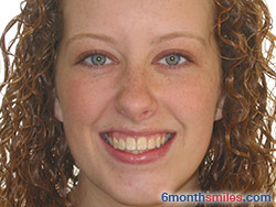 After 6 month smiles From Your Swindon Dentist