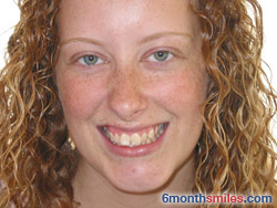 Before 6 month smiles From Your Swindon Dentist