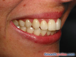 After 6 month smiles From Your Swindon Dentist