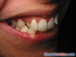 Before 6 month smiles From Your Swindon Dentist