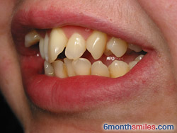 Before 6 month smiles From Your Swindon Dentist