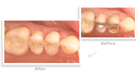 teeth whitening