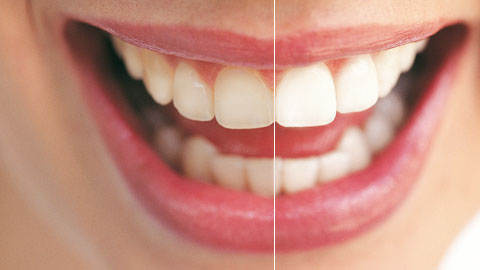 teeth whitening